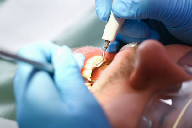 Best Dentist for Tooth Abscess  in Parker, TX